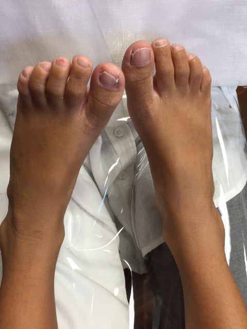 Testimonial on Psoriasis & Athlete Foot